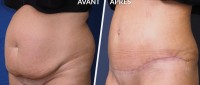 différence entre une plastie abdominale et une liposuccion